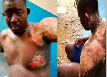 Wife’s Hot Water Attack Burns Husband In Niger