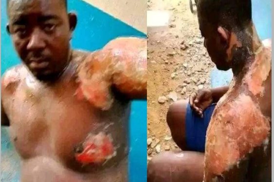 Wife’s Hot Water Attack Burns Husband In Niger
